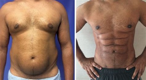 Doctors Can Turn Your Belly Fat Into Six Pack Abs And You Dont Need