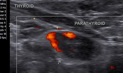 Parathyroid Adenoma Diagnosed On Ultrasound In A Sestamibi Negative