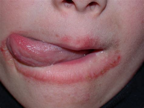 Lip Eczema Cause Symptoms On Baby How To Treat Cure Home Remedies