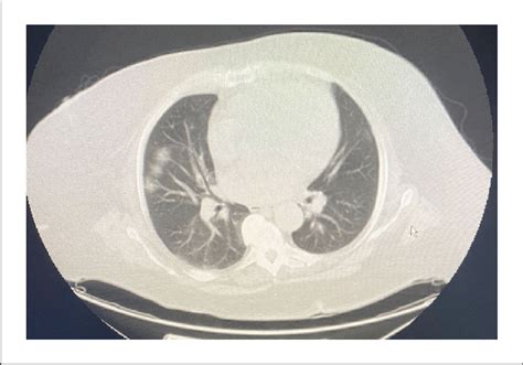 Computed Tomography Chest With Peripheral Air Space Disease In The