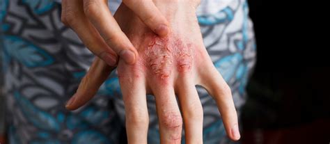 Dermatite Atópica O Que é E Como Tratar Dermatologista No Rio De