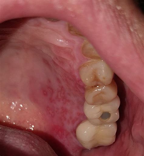 Oral Vesiculobullous Lesions Associated With Sars‐cov‐2 Infection
