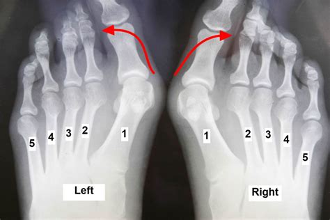 Foot Bunion Causes Symptoms And Treatment To Correct Bunion