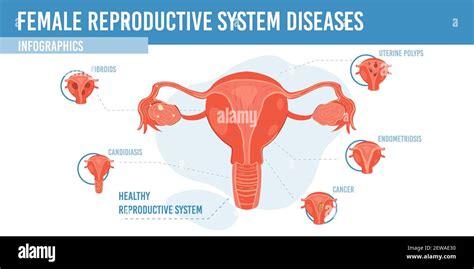 Flat Cartoon Infographic Female Reproductive System Diseases Vector Illustration Concept Stock