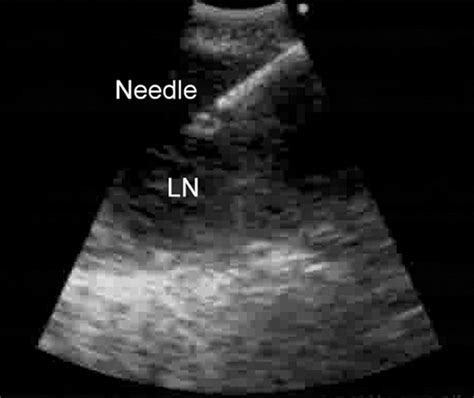 Real Time Endobronchial Ultrasound Guided Transbronchial Needle