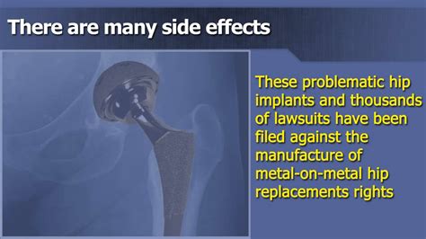 Stryker Hip Replacements Lawsuit Join Now Youtube