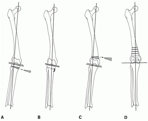 High Tibial Osteotomy Jaaos Journal Of The American Academy Of
