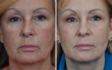 Laser Skin Resurfacing Before And After Annapolis Plastic Surgery