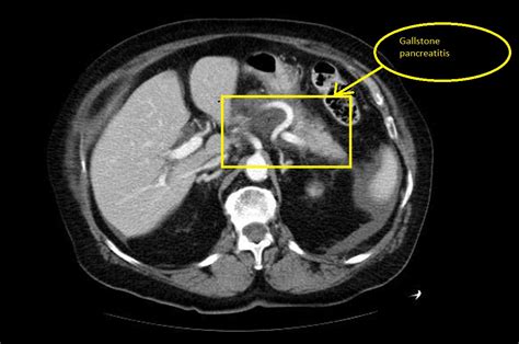 Acute Pancreatitis Ct Wikidoc