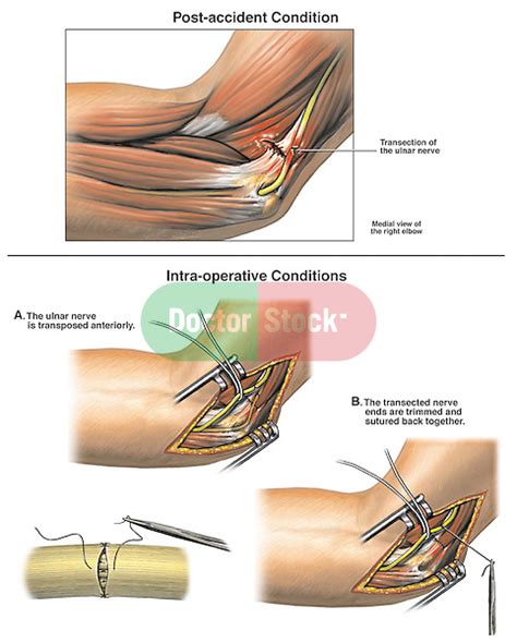 Ulnar Nerve Injury With Surgical Repair Doctor Stock