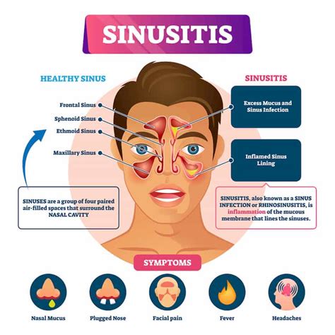 6 Common Symptoms Of Chronic Sinusitis To Watch Out For