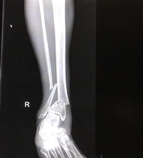 List 102 Pictures Broken Foot X Ray Pictures Stunning 102023