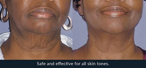 Morpheus8 Radio Frequency Skin Tightening Treatment Aesthetic