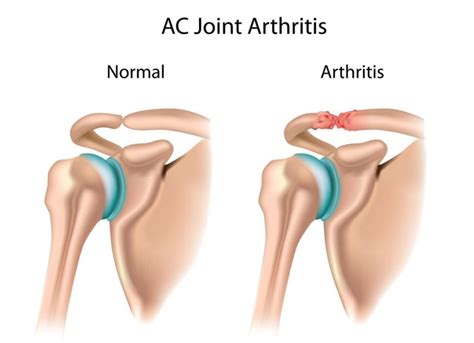 What Is Acromioclavicular Arthritis And How Does It Develop Upswing Health