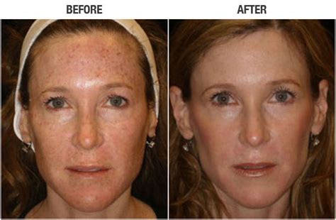 Ipl Photofacial And Skin Rejuvenation Dark Spot Removal