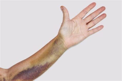 What Is The Color Of Your Bruise Trying To Tell You