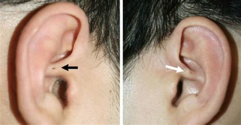 Tiny Hole In Ear 3