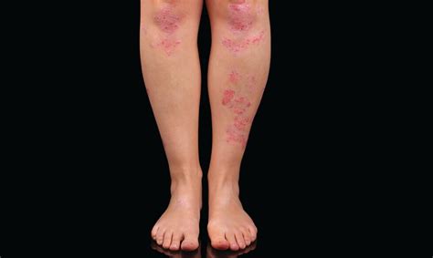 Questions And Answers About Psoriasis Nih Medlineplus Magazine