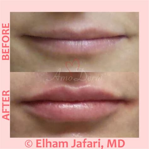 White Spots On Lips After Filler