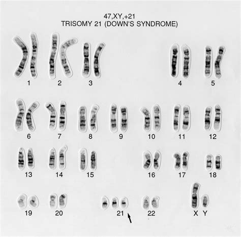 International Mosaic Down Syndrome Association Explaining Karyotypes My Xxx Hot Girl