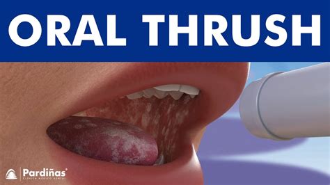 Oral Thrush Under Tongue