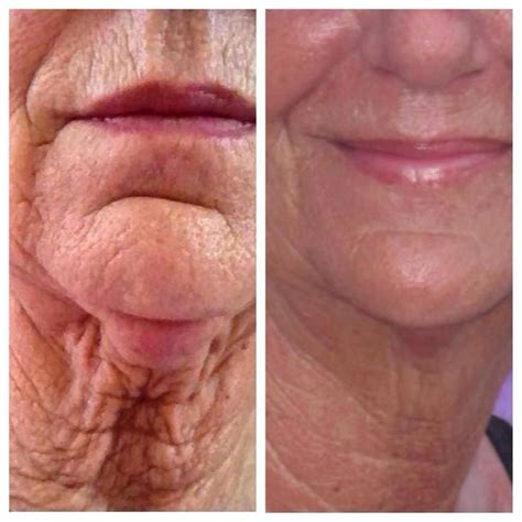 Before And After Pictures Nerium International 30 Day Money Back Guarantee Katiemosernerium