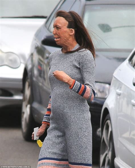 Turia Pitt Reveals How She Told Fiance She Was Pregnant Daily Mail Online