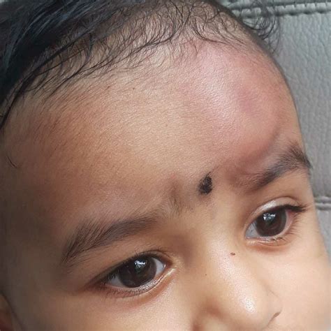 Asktheexpert My 10 Month Old Baby Accidently Fall Down While She Is