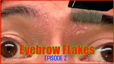 Eyebrow Flakes Episode 2 Dandruff Flakes Seborrheic Dermatitis