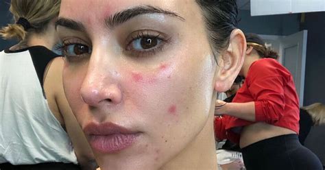 Kim Kardashians Tears Over Psoriasis Flare Ups At Most Important