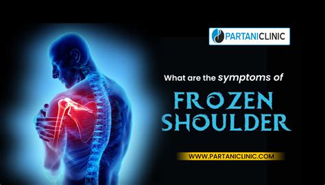 What Are The Symptoms Of Frozen Shoulder Partani Clinic