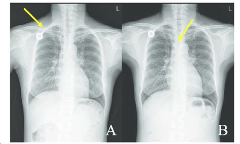 A Totally Implantable Venous Access Port Tivap On Chest Radiography