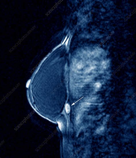 Breast Cancer Mri Scan Stock Image M1220441 Science Photo Library