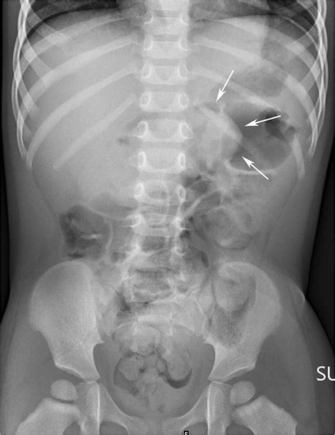 Target Sign Intussusception Abdominal X Ray Plain Abdominal Xray Of