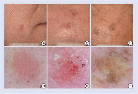 Clinical And Dermoscopic Grading Of Actinic Keratosis A B Grade 1