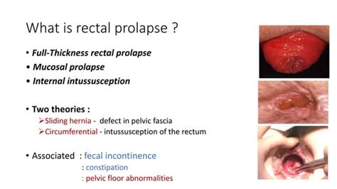 Rectal Prolapse Do We Really Have A Perfect Surgical Solution Pptx