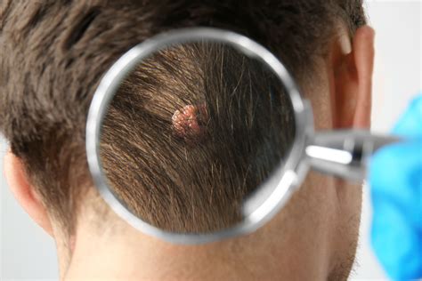 Skin Cancer Moles On Head