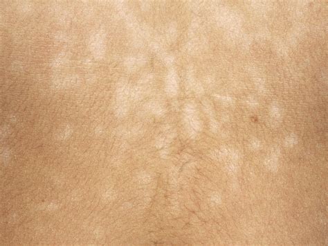 Tinea Versicolor Babycenter