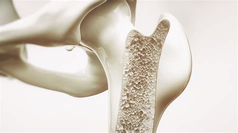 Fda Approves Prolia For Glucocorticoid Induced Osteoporosis Drug