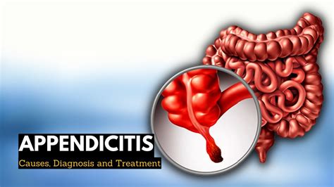 Appendicitis Causes