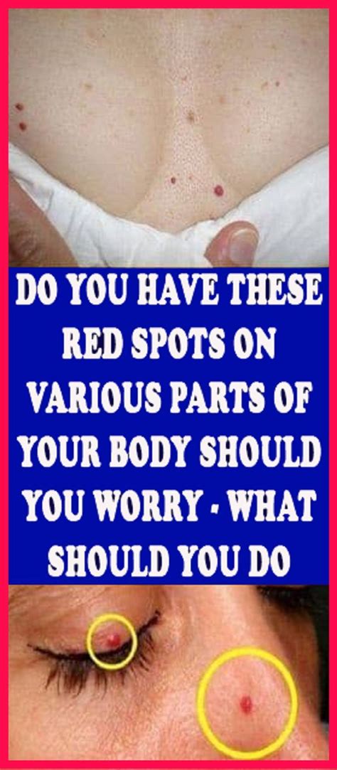 Do You Have These Red Spots On Various Parts Of Your Body Health