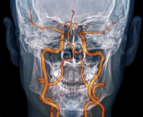 Cervical artery dissection is a dissection of any of the arteries in the neck. Neck Arteries To The Brain Photograph by Zephyr/science Photo Library