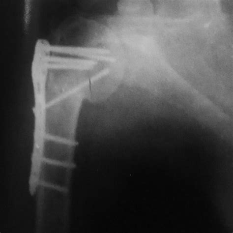 Final Follow Up Radiograph With Collapse Of The Fracture Into Varus