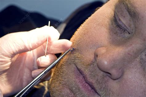 Removing Stitches From The Face Stock Image C0028787 Science