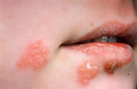 It may result in small blisters in groups often called cold sores or fever blisters or may just cause a sore throat. Myriad of Important Facts About Herpes, symptoms and causes