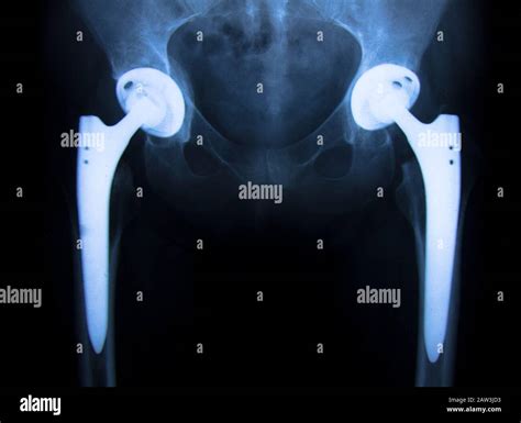 Hip Osteoarthritis X Ray Hi Res Stock Photography And Images Alamy