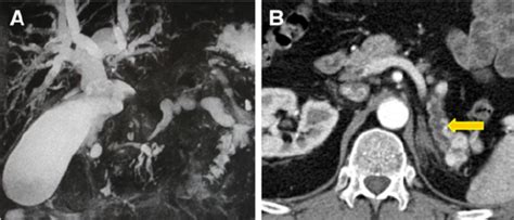 Obstruction Of The Common Bile Duct With Upstream Dilatation Of The