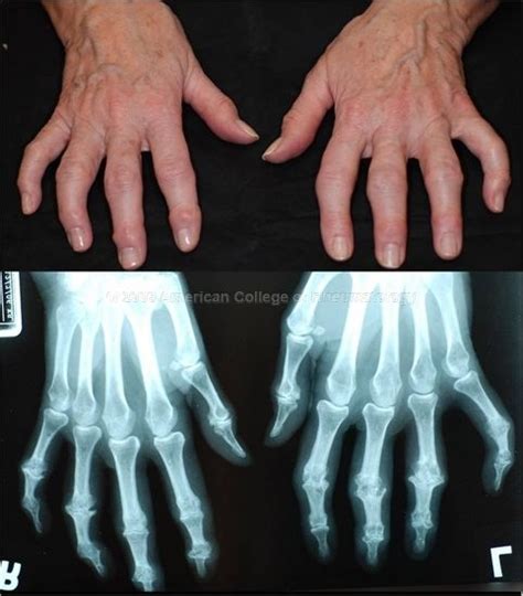 Erosive Osteoarthritis Hands Osteoarthritis Pharmacology Nursing