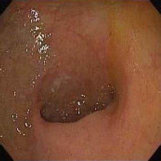 Biopsy Showing A Squamous Mucosa With Acute Inflammation And Reactive