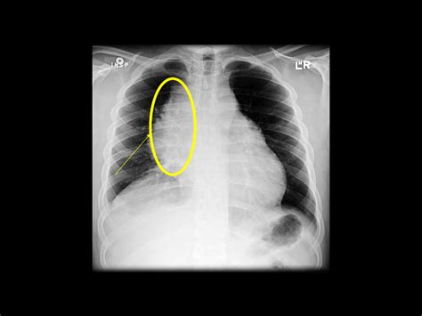 Primary Mediastinal Large B Cell Lymphoma X Ray Wikidoc